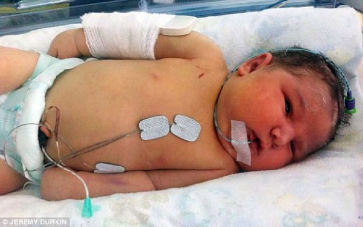 Médico quebra braço de bebê gigante durante parto para salvar vida da criança 