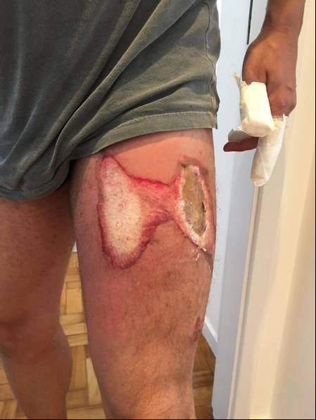 Celular pega fogo no bolso da calça e deixa homem com queimaduras na perna e mãos
