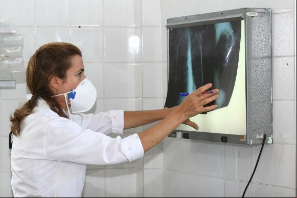 Brasil tem 34% dos casos de coinfecção de tuberculose e HIV do mundo