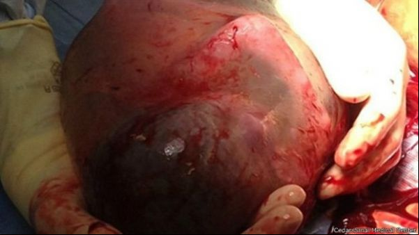 Bebê nasce dentro de bolsa amniótica e surpreende médicos