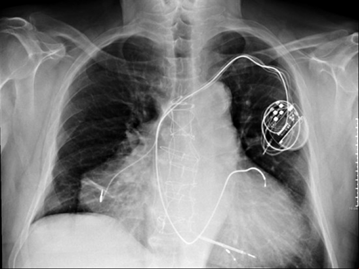 Conheça o homem que possui dois corações e foi internado tendo infarto duplo