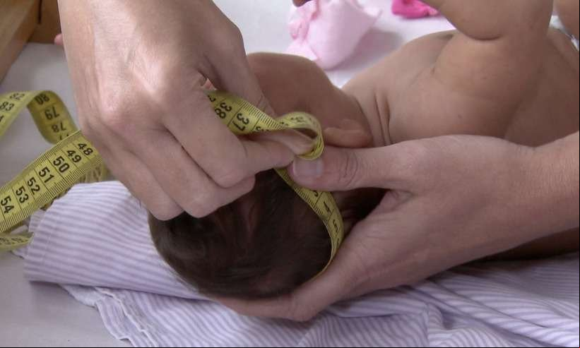 Especialistas levam ao Senado dados sobre impacto da zika em bebês