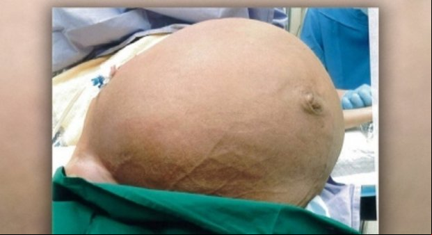 Mulher retira tumor de 10 quilos da barriga