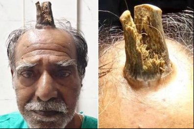 Homem tem 'chifre' de 10cm removido em cirurgia