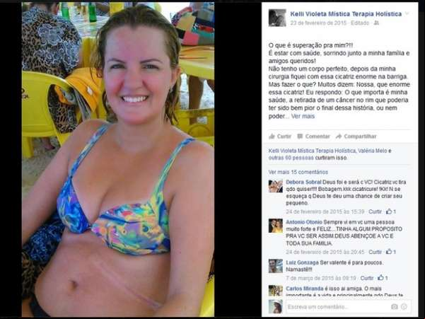 Mulher exibe com orgulho cicatriz de 18 cm após câncer: 'Chance de vida'