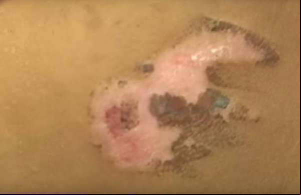 Castigo cruel: mulher queima o rosto do filho de quatro anos com garfo quente
