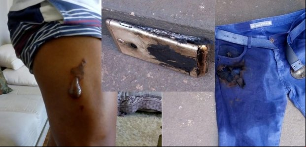 Celular explode no bolso de calça e queima perna de enfermeiro