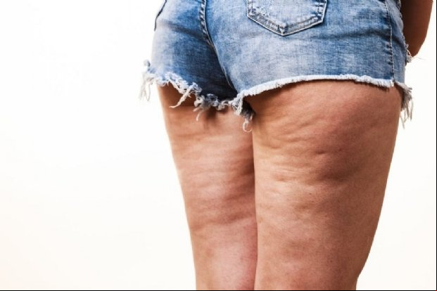 Nutricionista dá dicas de quais alimentos ajudam a acabar com a celulite