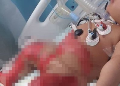 Bebê toma banho em água a 50º C